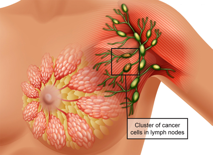 স্তন ক্যানসারের
