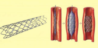 হার্টের রিংয়ের দাম কমছে ৮৮ হাজার টাকা পর্যন্ত
