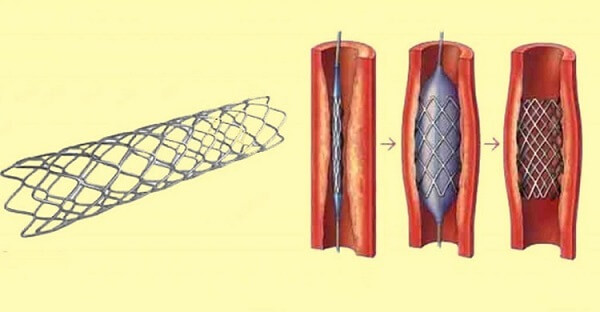 হার্টের রিংয়ের দাম কমছে ৮৮ হাজার টাকা পর্যন্ত